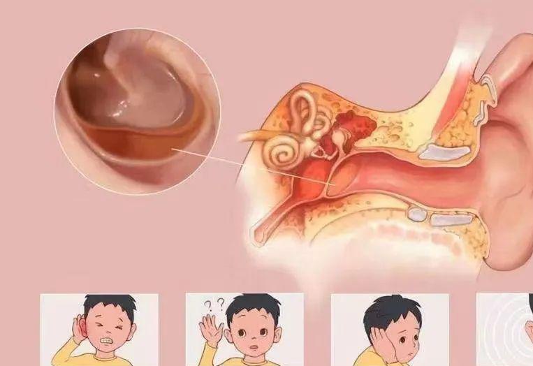 耳炎详解，症状、成因、治疗与预防措施