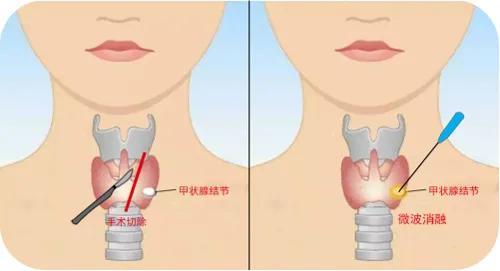 甲状腺结节自测图，轻松掌握健康信息！